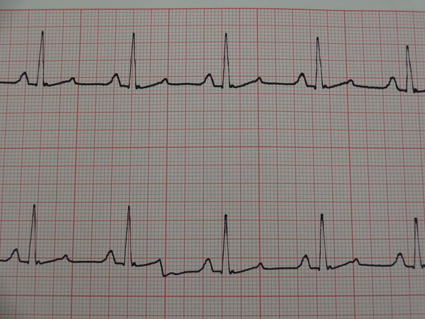 Elektrokardiogramm (EKG)